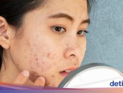 Batasi Konsumsinya! 7 Konsumsi Pemicu Jerawat Parah Ke Orang Dewasa