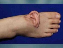 Ahli Bedah China Pindahkan Telinga Wanita Hingga Kaki Pada 5 Bulan