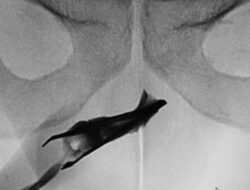 Ngilu! Momen Praktisi Medis Temukan Pinset ‘Nyangkut’ Ke Mr P Pada 4 Tahun